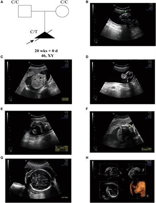 Case report: A de novo Non-sense SOX9 mutation (p.Q417*) located in transactivation domain is Responsible for Campomelic Dysplasia